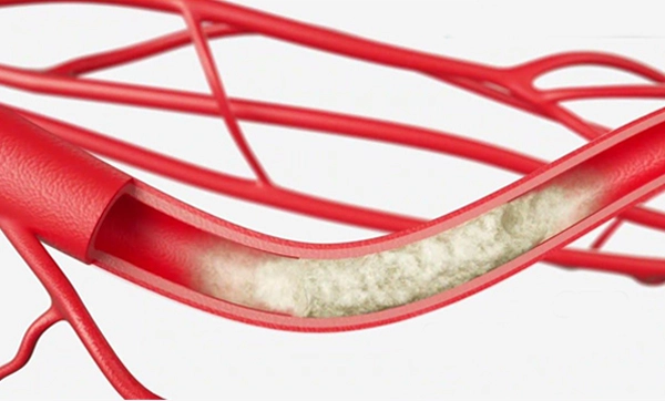  CTO Intervention (Chronic Total Occlusion)