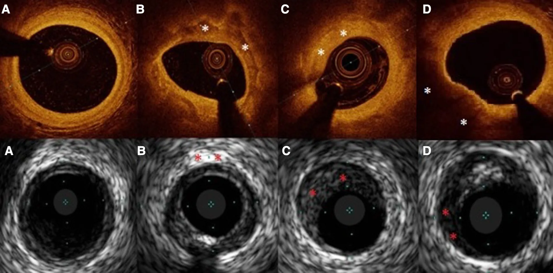 IVUS / OCT / FFR guided Angioplasty 