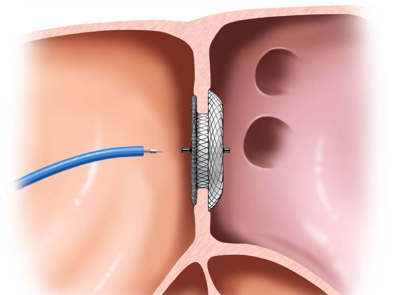 ASD Device Closure