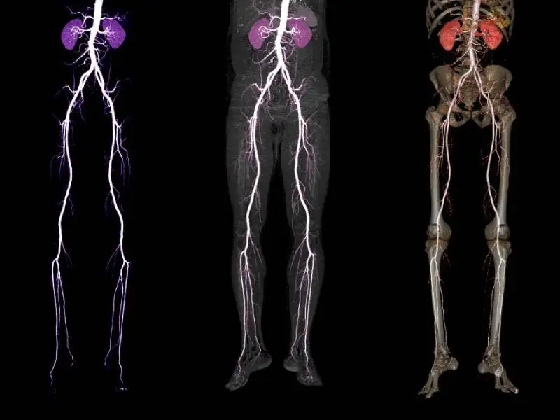 Peripheral Angiography 