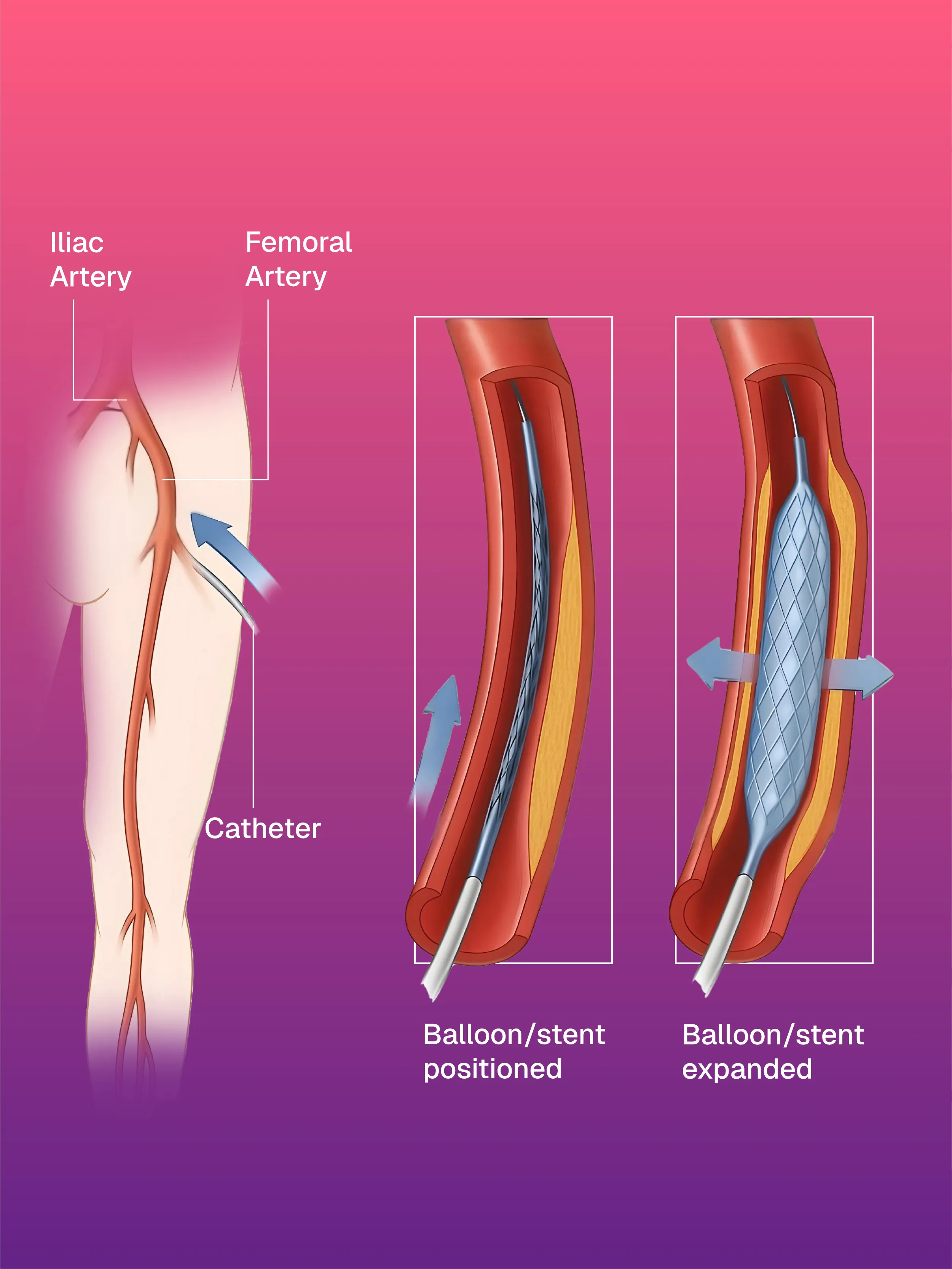 Peripheral Angioplasty