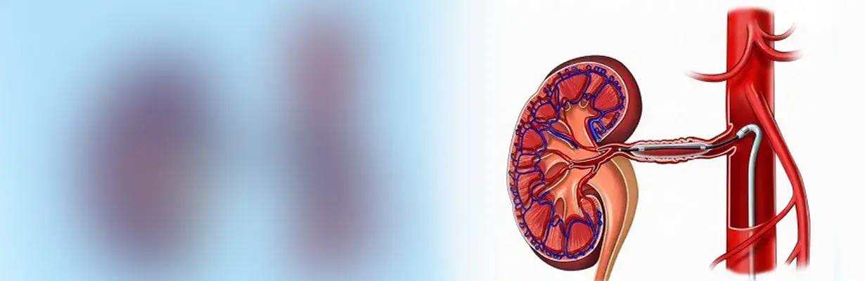 Renal Angioplasty