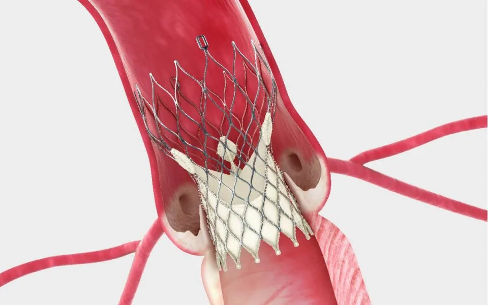 Valvular Heart Disease 