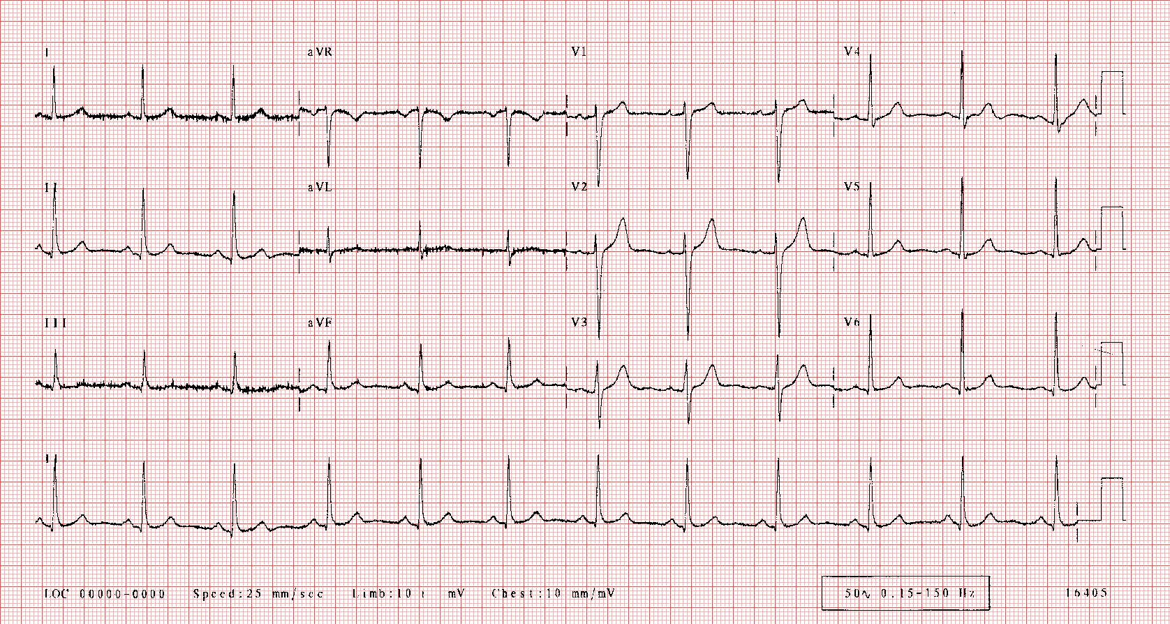 ECG Interpretation 