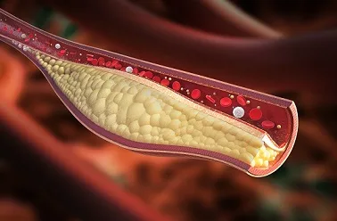 Cholesterol (Lipid) management