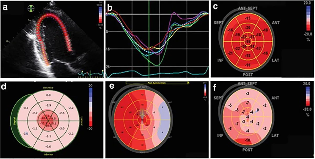 Cardiac Monitoring During Chemotherapy