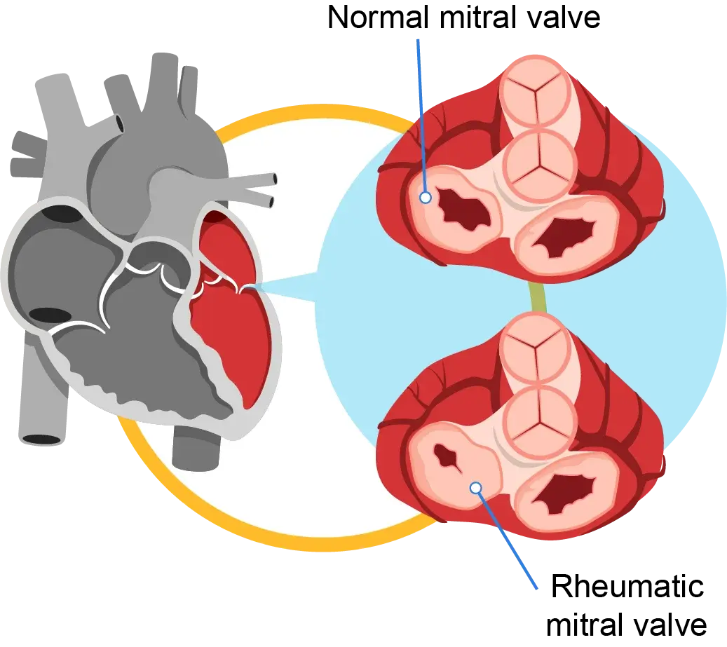 Rheumatic Heart Disease