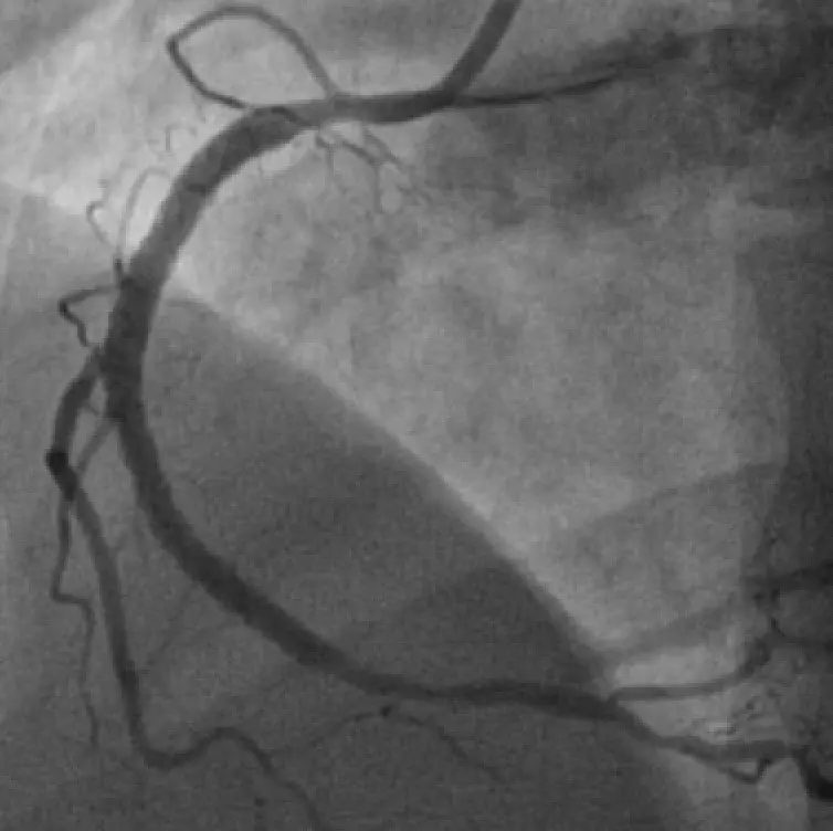 Coronary Angiography
