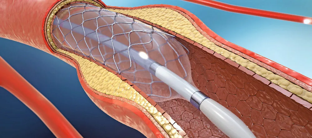 Coronary Angioplasty (PTCA)