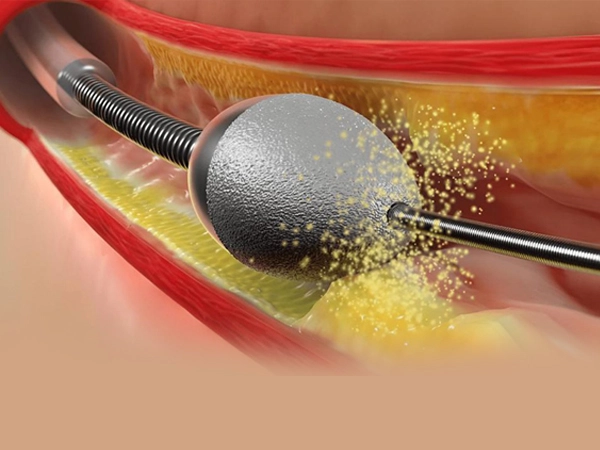 Rotablation (Rotational Atherectomy) 