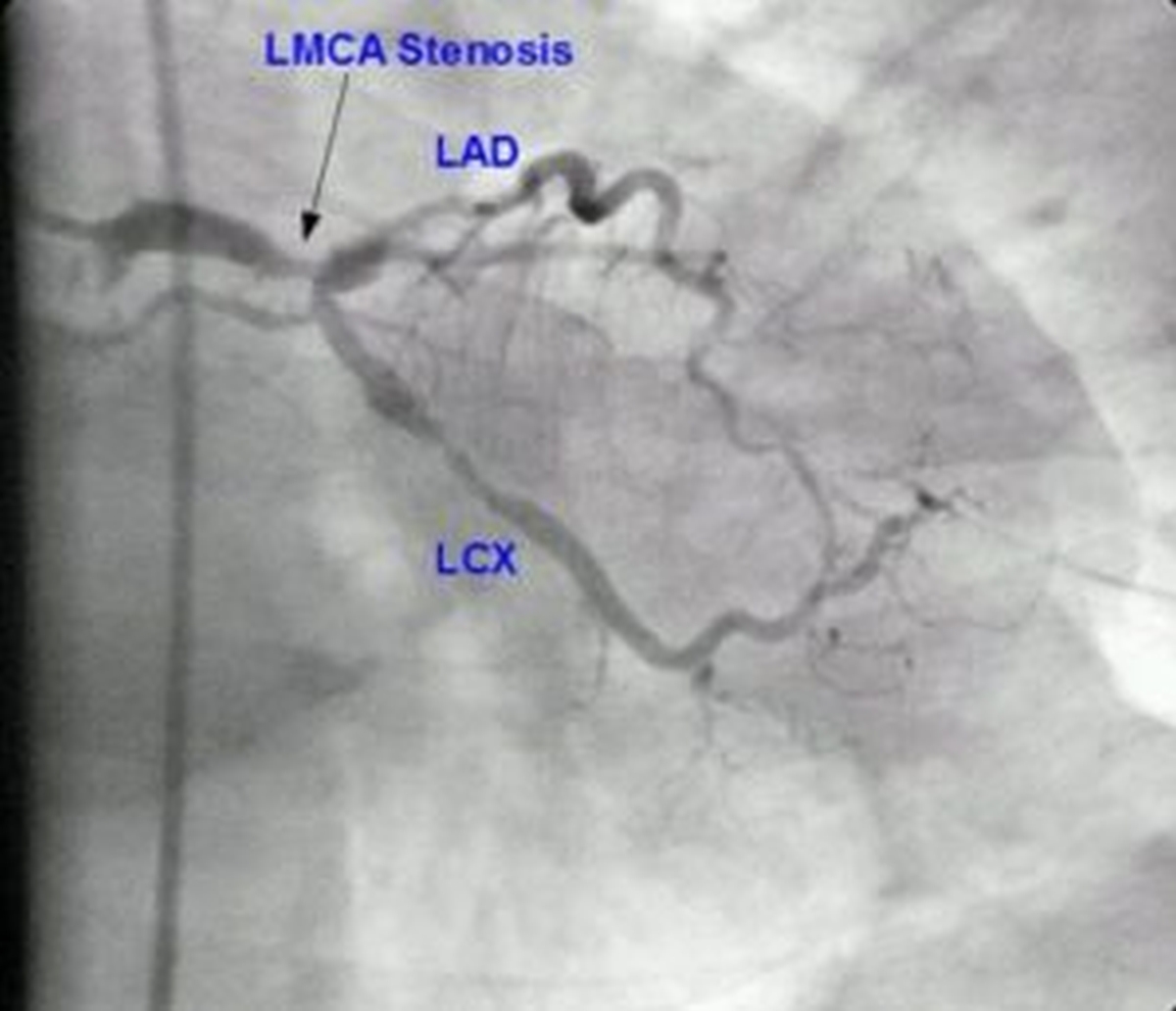 Complex PCI – Left Main / Bifurcation Angioplasty