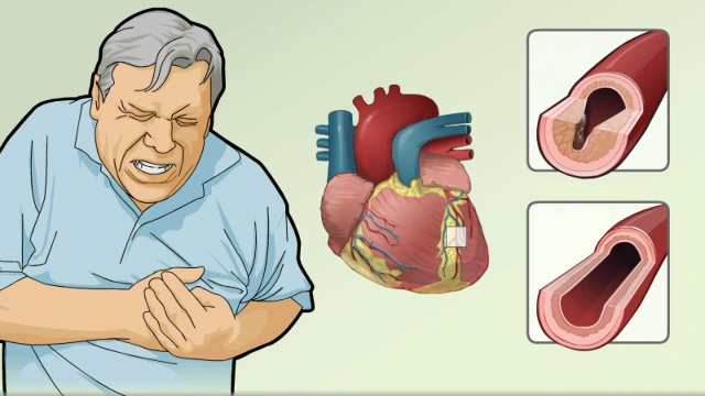 Chest Pain / Angina