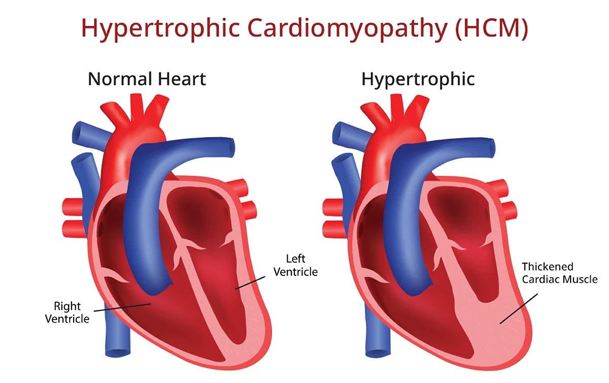 Cardiomyopathy
