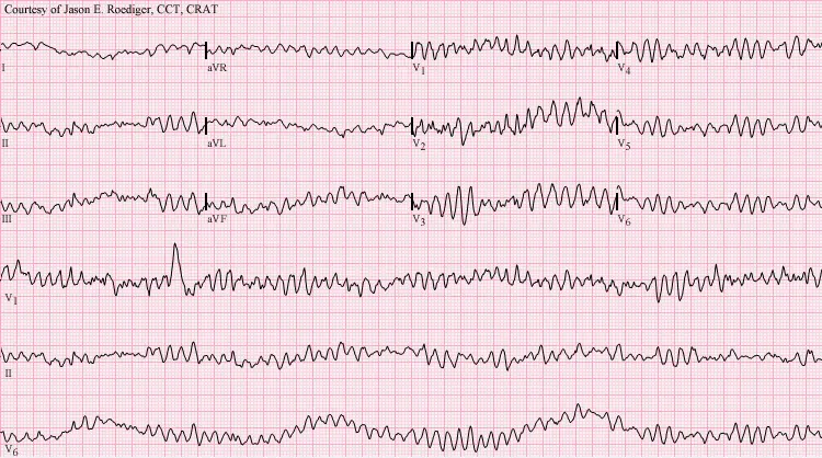 Arrhythmias