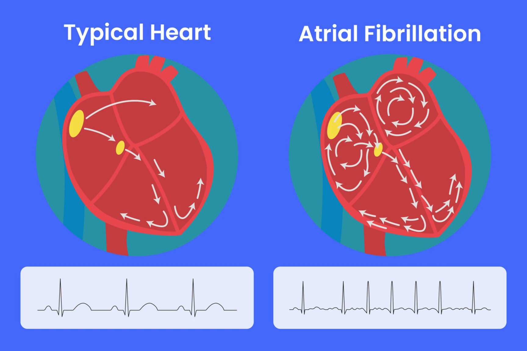 Atrial Fibrillation