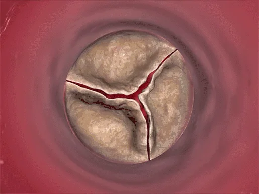Valvular Heart Disease