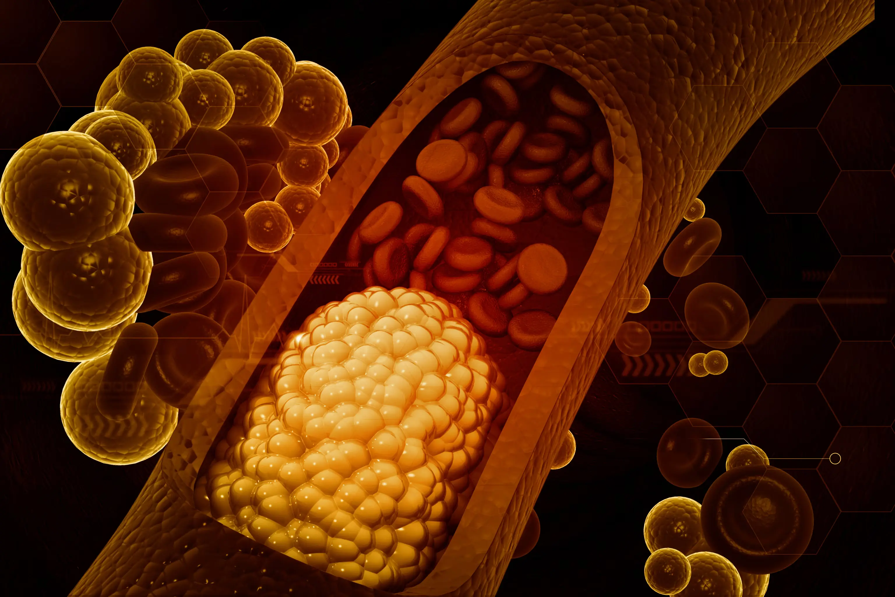 High Cholesterol