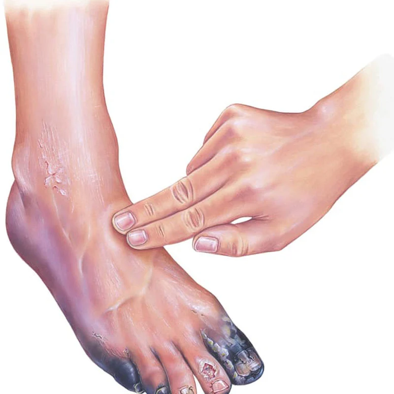 Peripheral Arterial Disease