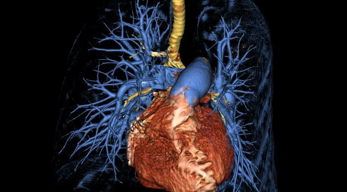 Pulmonary Hypertension